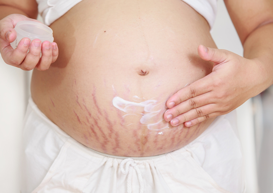 Stretch Marks: How To Avoid Them During Pregnancy