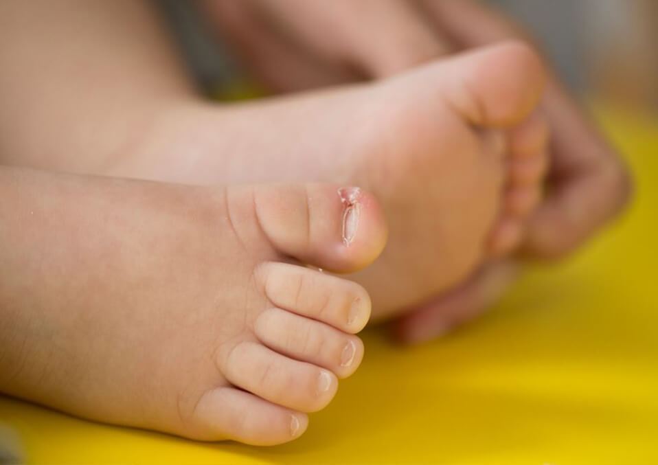 Baby Care  Ways on Dealing With Baby Ingrown Toenails