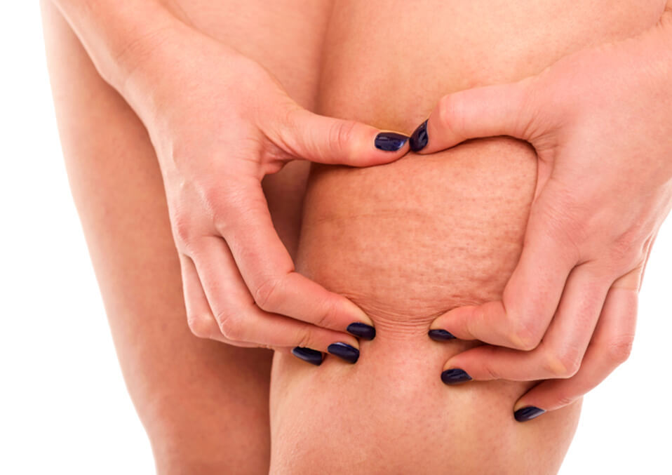 Cellulite During Pregnancy: Prevention And Cure