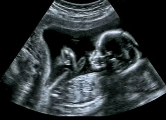 Prenatal Ultrasound: What You Should Know