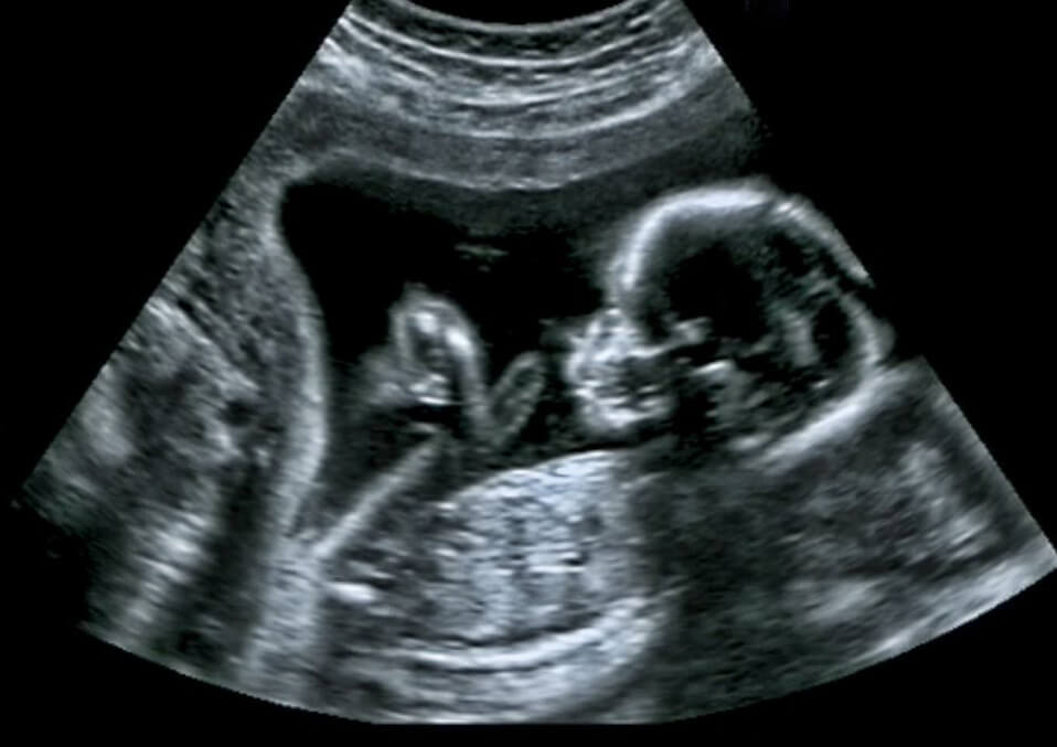 Prenatal Ultrasound: What You Should Know