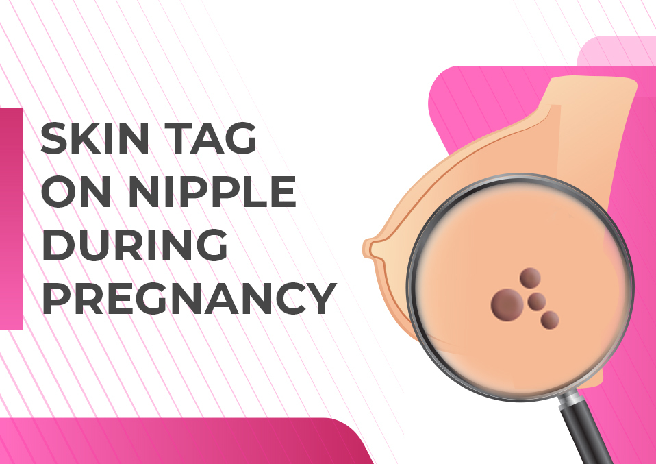 Skin Tag On Nipple During Pregnancy