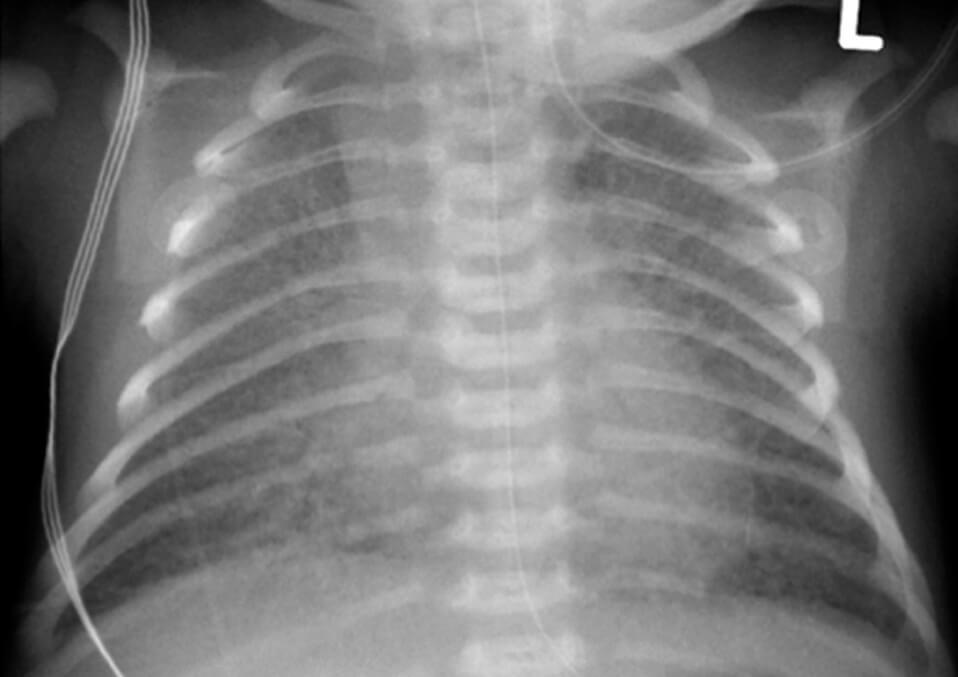 Transient tachypnea of the newborn