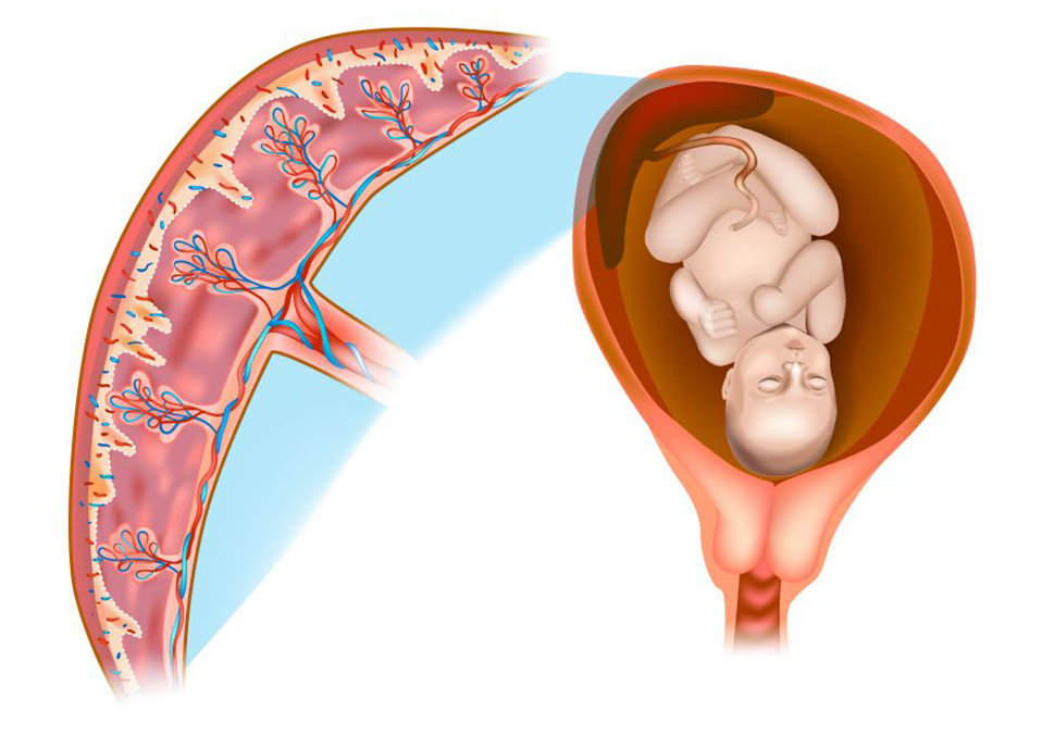 What Is a Chorionic Villus Sampling Test