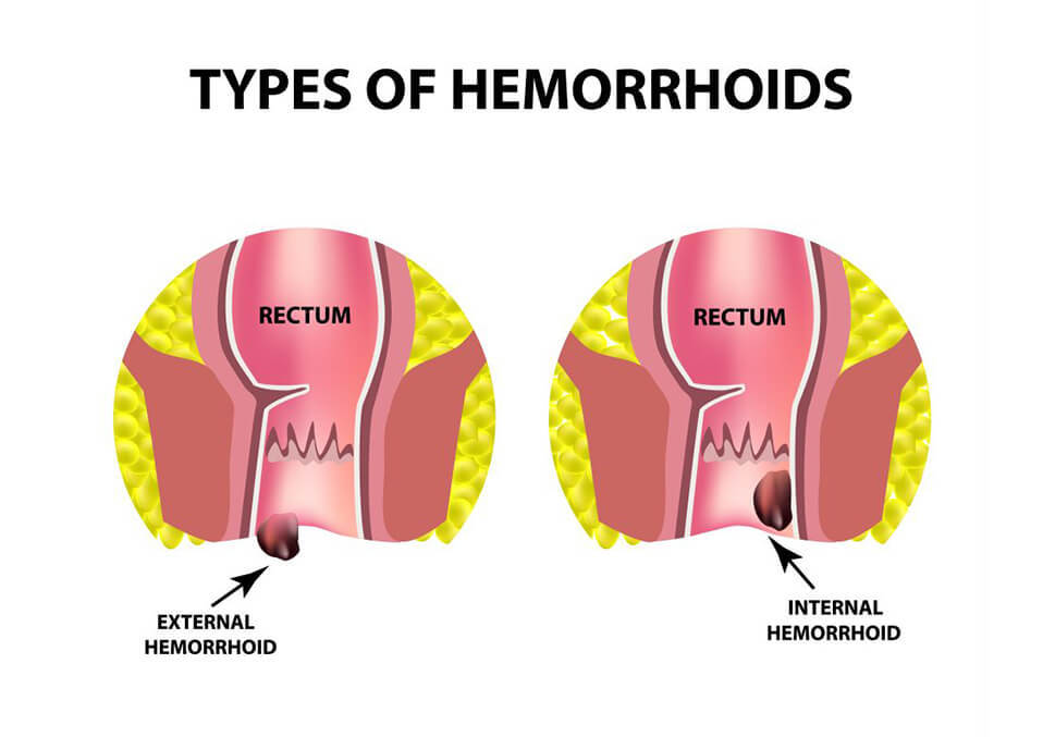 What are hemorrhoids? 