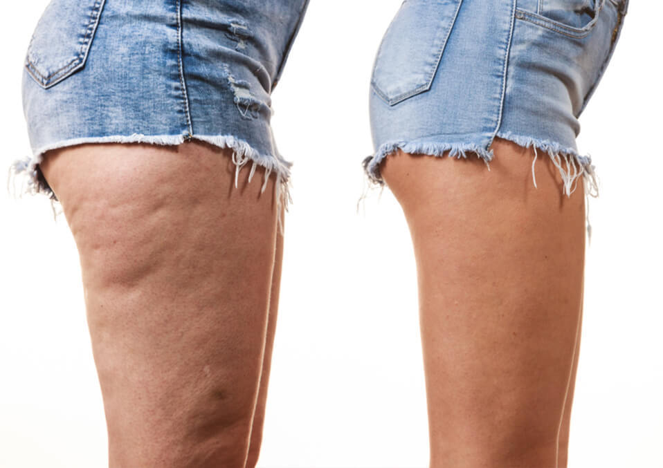 What is cellulite? 