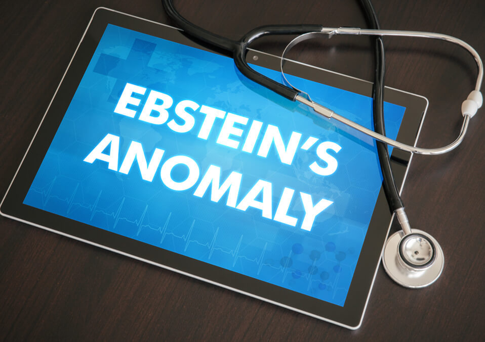 Ebstein's Anomaly in Kids