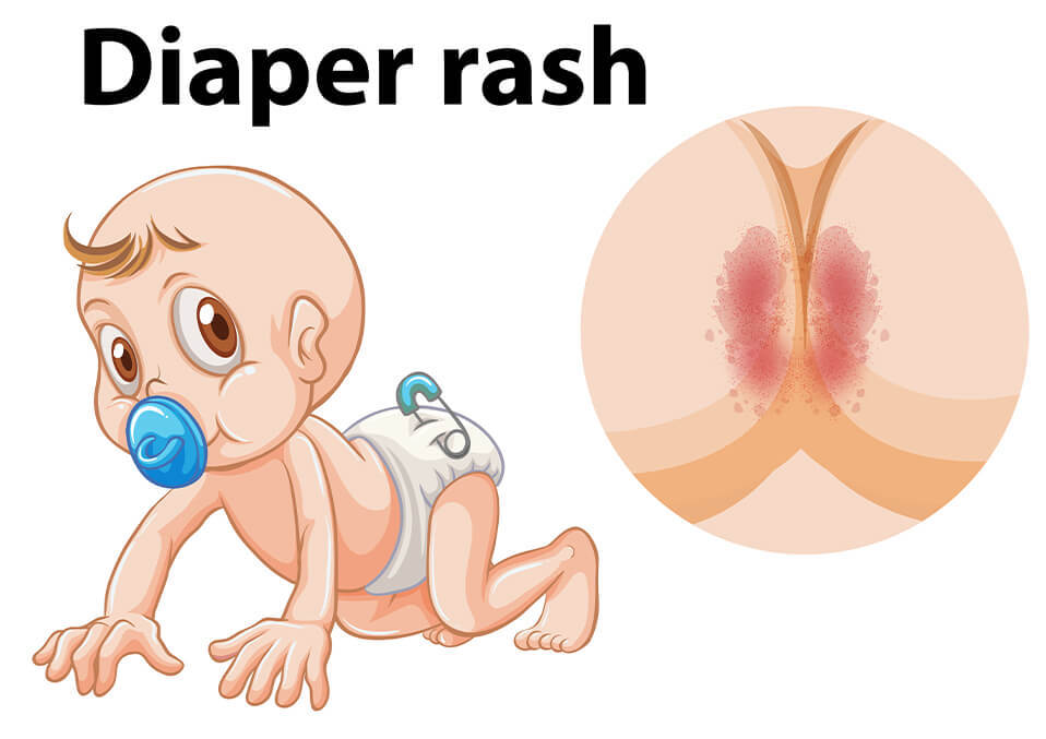 Effective Home Remedies for Diaper Rash