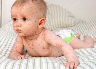 The Most Common Childhood Rashes - Facts Every Mom Should Know