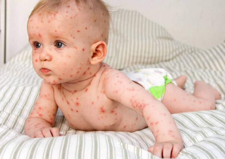 The Most Common Childhood Rashes – Facts Every Mom Should Know