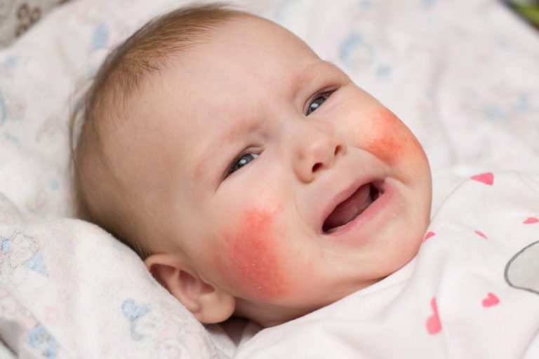 How to Treat Hives in Babies