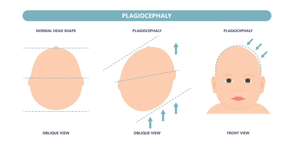 Why Do Babies Wear Helmets?, baby flat head, baby plagiocephaly