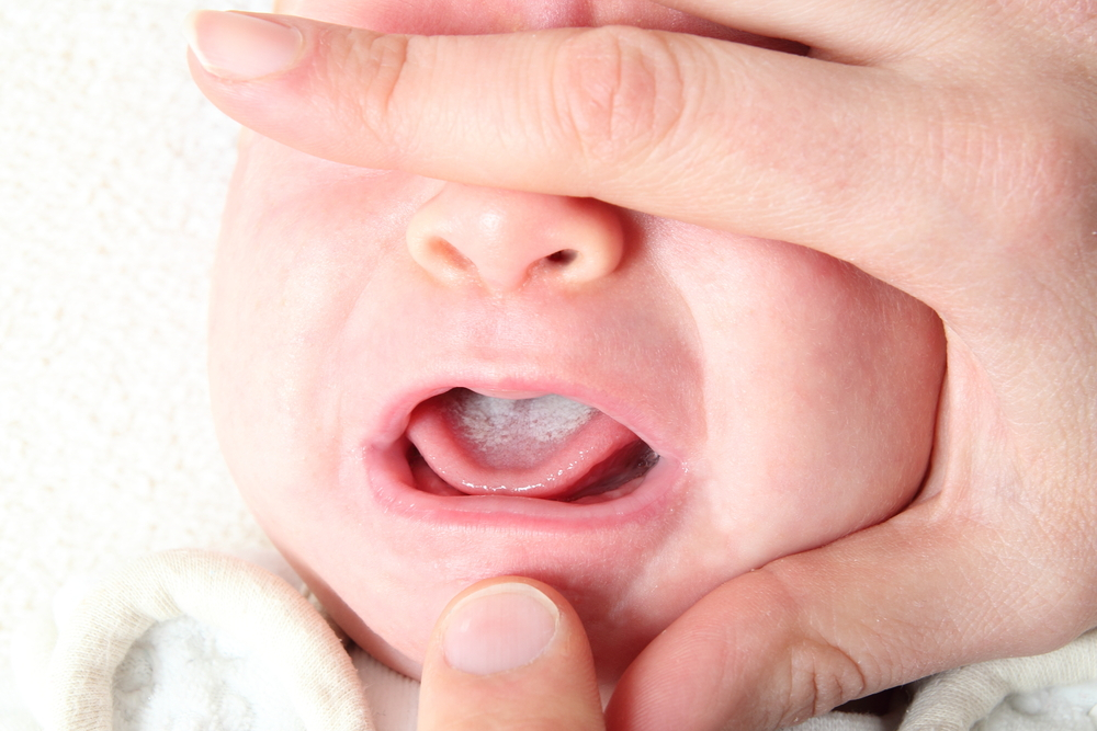 Everything You Need to Know About Thrush in Babies