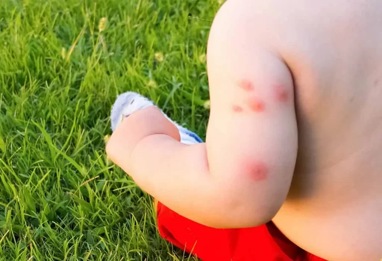 How to Identify and Treat Bed Bug Bites in Babies